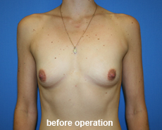 plastic-surgery-breast-augmentation